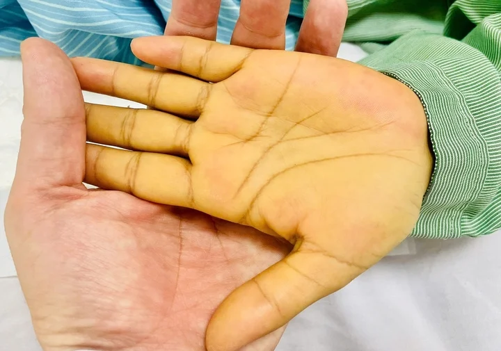 5 dấu hiệu nhận biết sớm ung thư gan không nên bỏ qua