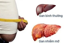 Người bị gan nhiễm mỡ bao lâu nên đi khám một lần?