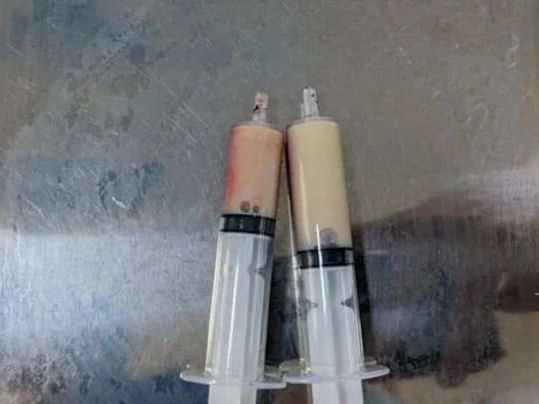 Cấp cứu người đàn ông bị mỡ máu 'đông đặc'